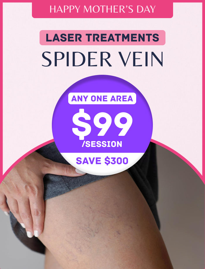 Spider Vein