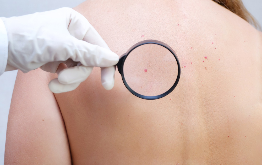 Laser-Cherry Angioma