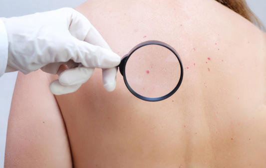 Laser-Cherry Angioma