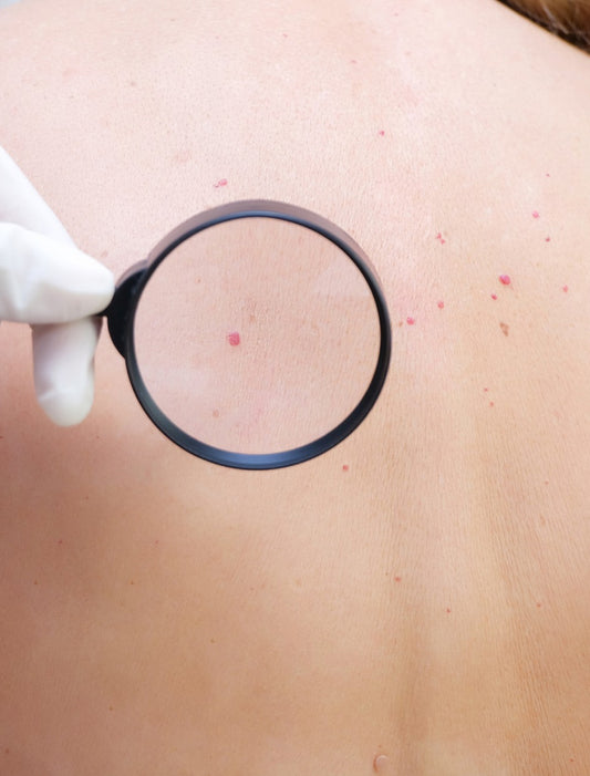 Laser Treatment - Cherry Angioma - Single Session